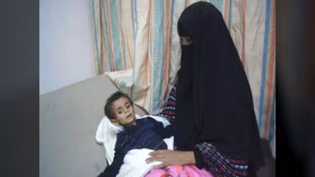 679 طفلاً مصاباً بالحصبة خلال عام في اليمن