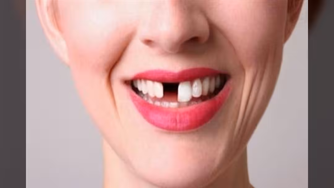 ماذا تفعل عندما تفقد أحد أسنانك؟