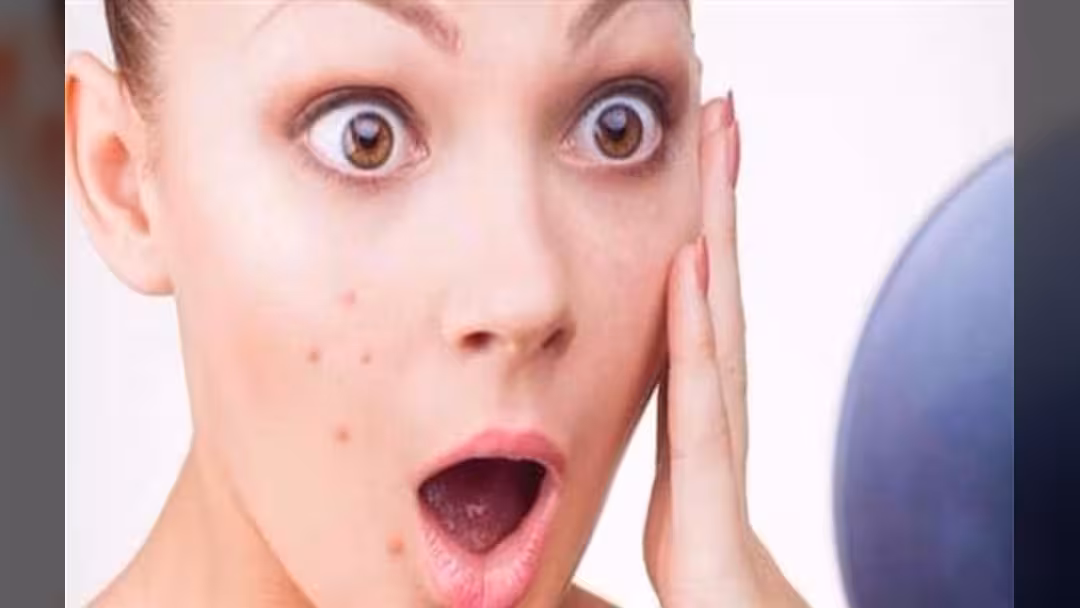 هذه الأطعمة تهدد بشرتك بالبثور