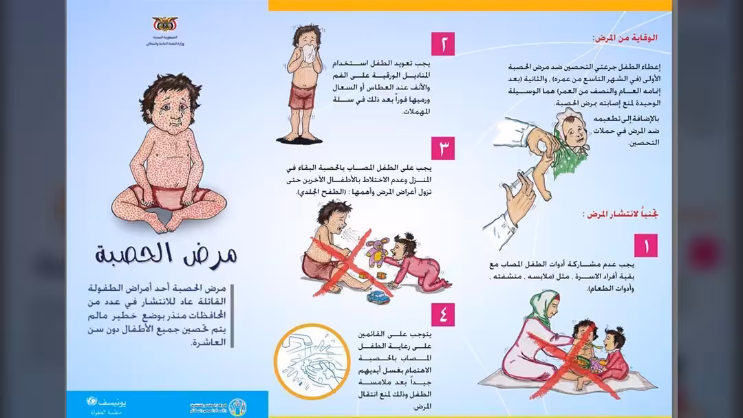 الإعلان عن ثلاث وفيات بسبب مرض الحصبة في البيضاء
