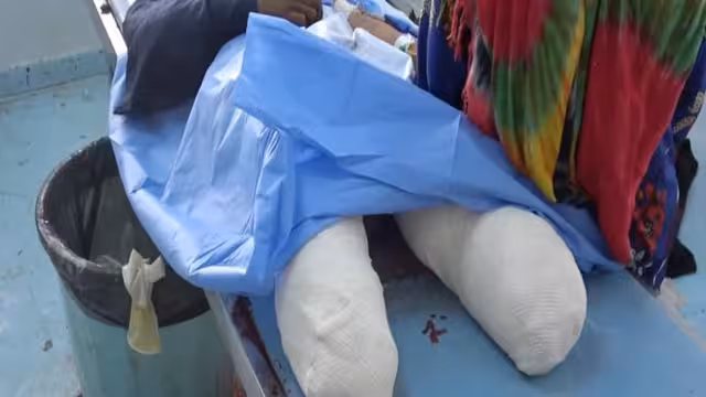 طفلة نازحة تفقد ساقيها بانفجار لغم حوثي في حيس