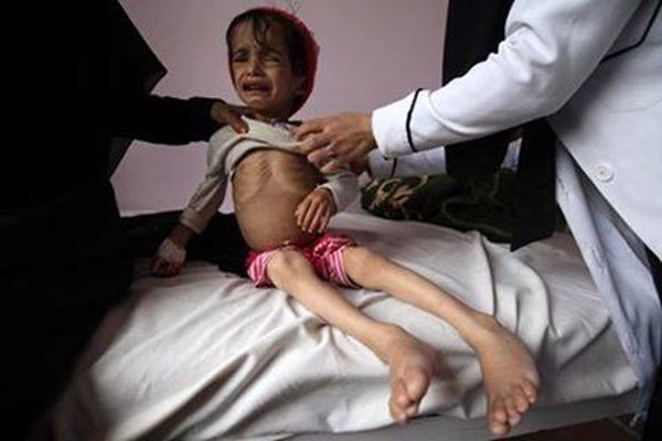 يونيسف: سوء التغذية يعرض أطفال اليمن لخطر الموت