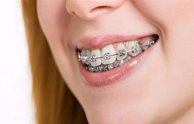 تقويم الأسنان متى يكون ضرورياً؟