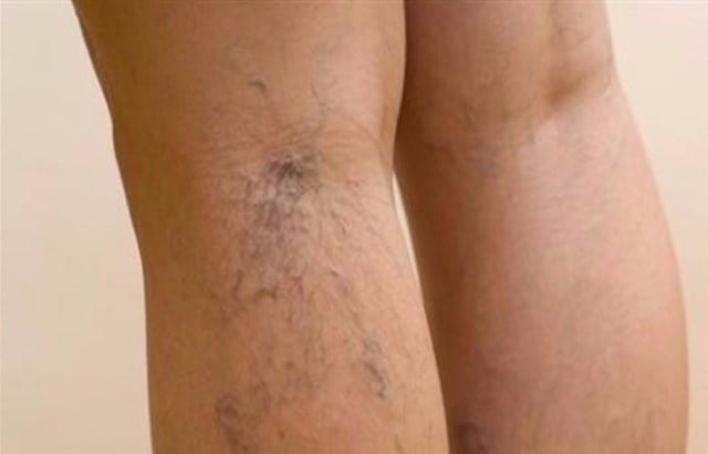 نصائح لعلاج دوالي الساقين دون جراحة