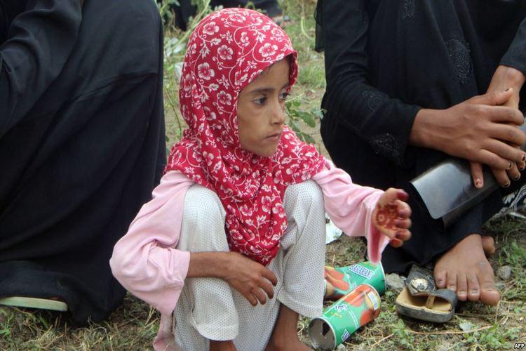مجاعة في اليمن - أطفال اليمن