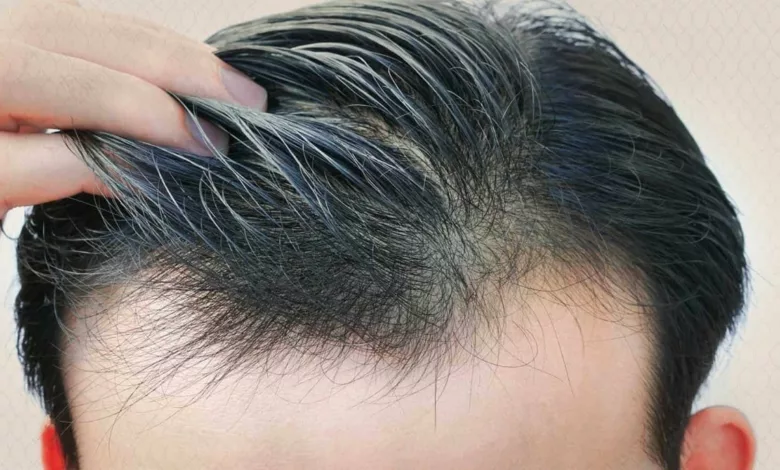 عوامل تتوقف عليها زارعة الشعر